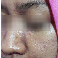 Before — Bruntusan dan Pori-Pori Besar